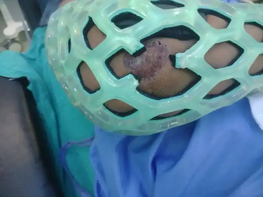 Close-up of a FlexiOH immobilizer lattice on skin