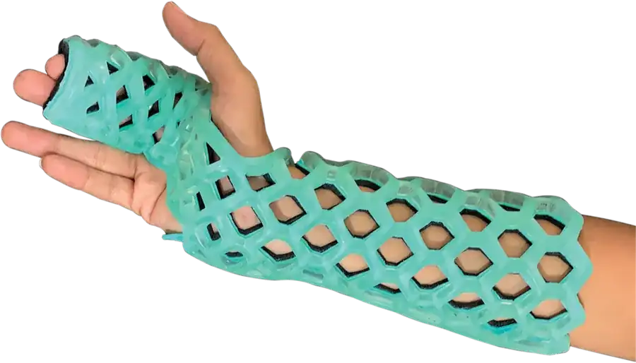Radial Gutter Immobilizer — FlexiOH light-cured polymer immobilizer