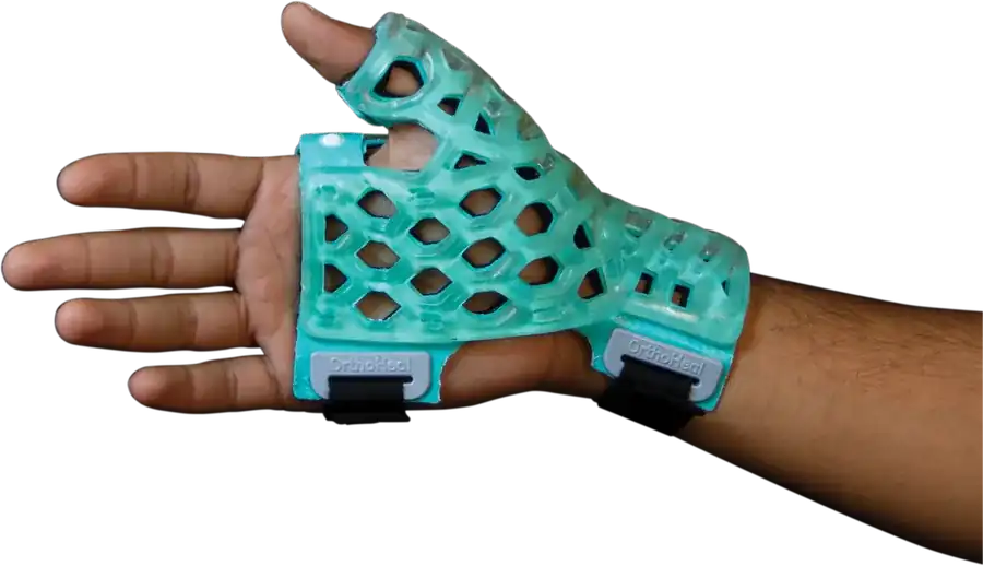 Thumb Spica Immobilizer — FlexiOH light-cured polymer immobilizer