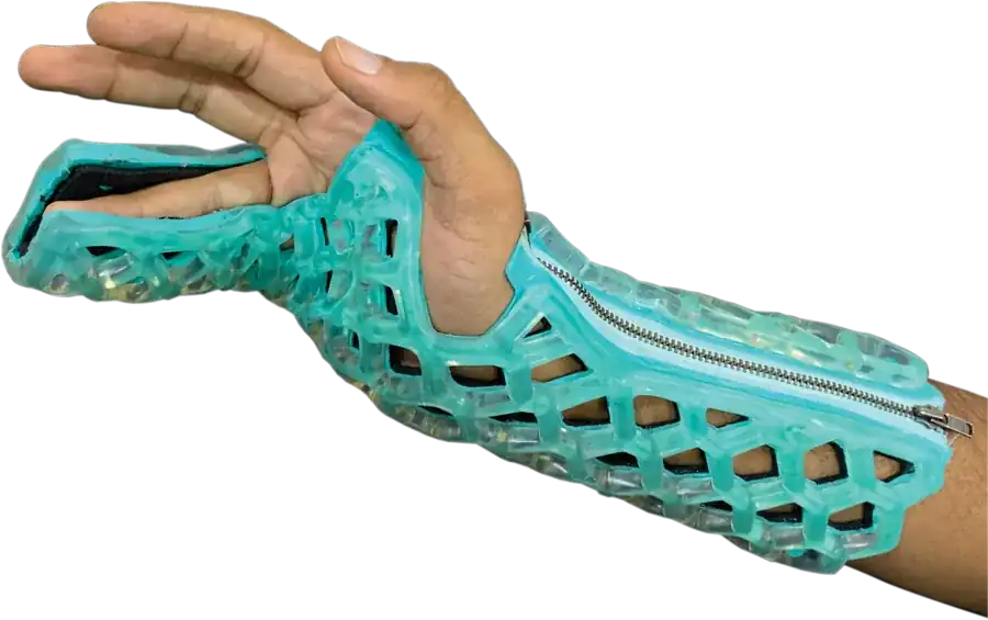 Ulnar Gutter Immobilizer — FlexiOH light-cured polymer immobilizer